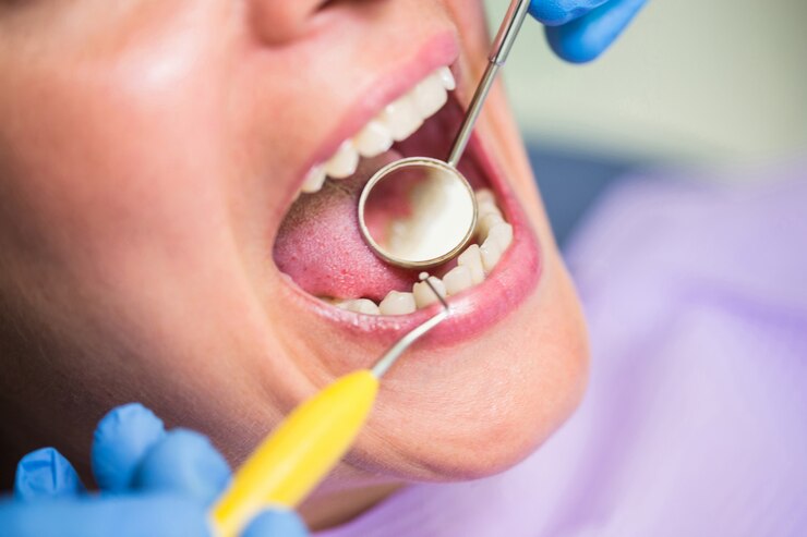 Tooth Extractions in Lakewood Ranch